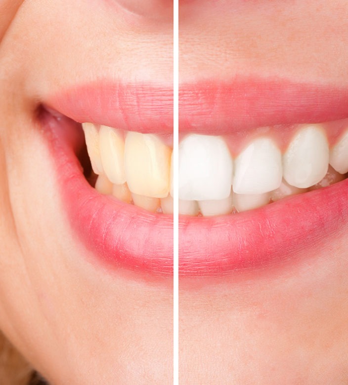 Teeth Whitening South Calgary Dental & Orthodontics SE Calgary