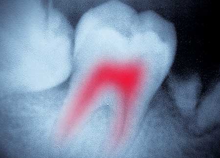 Root Canal Therapy | Legacy Family Dental