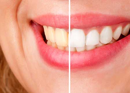 SE Calgary Teeth Whitening | South Calgary Dental & Orthodontics | General and Family Dentist and Orthodontist | SE Calgary