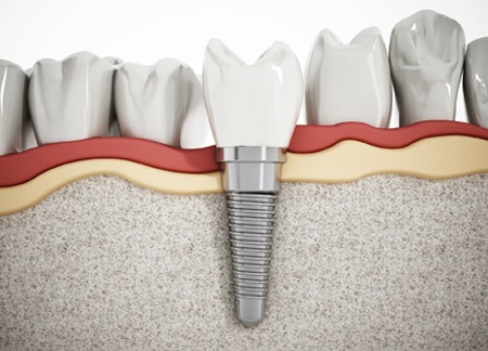 SE Calgary Dental Implants | South Calgary Dental & Orthodontics | General and Family Dentist and Orthodontist | SE Calgary